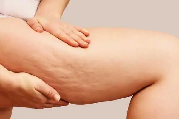 Image of woman showing leg with cellulite Diss