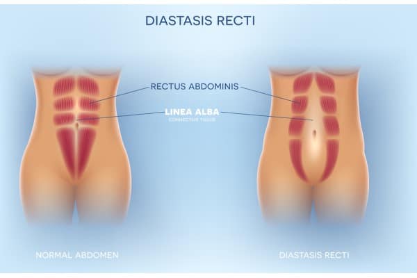 What Non-Surgical Options Are Available for Diastasis Recti Diss?