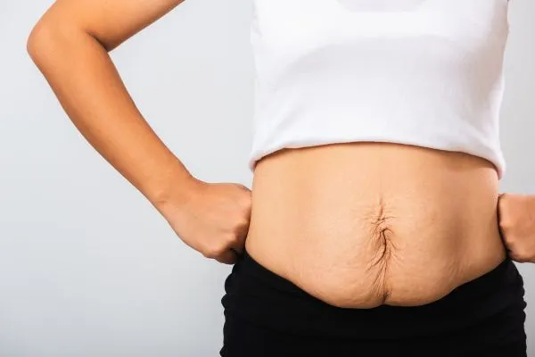 Image of a woman's stomach after weight loss with sagging skin following a gastric band Diss